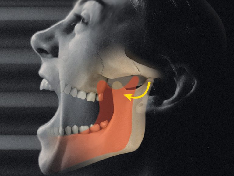 De uma Mandíbula Travada para a Osteoartrite: Descoberta do Hadassah Leva a  Novo Tratamento - Hadassah Brasil