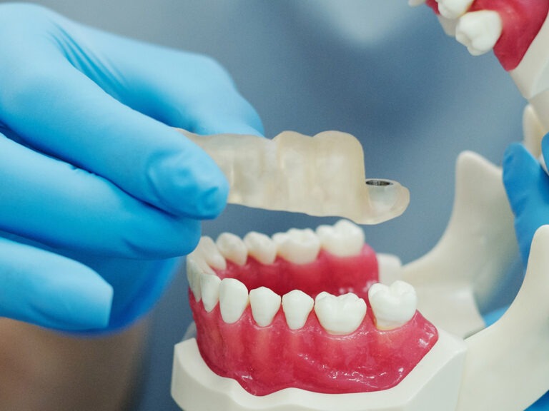 Placa Oclusal. Foto Pexels – Bakytzhan Baurzhano